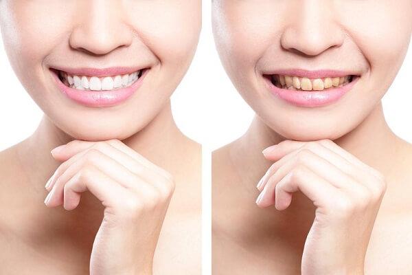 Những kiến thức về bọc răng sứ cần biết Những kiến thức về bọc răng sứ cần biết