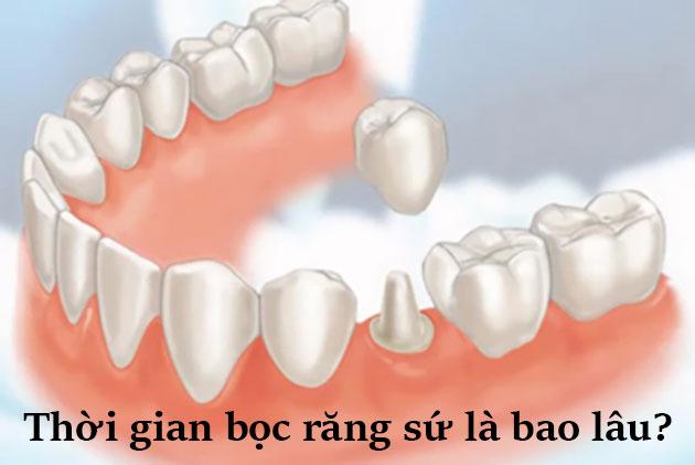 Những kiến thức về bọc răng sứ cần biết