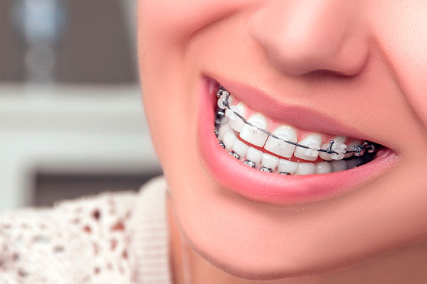 Cấu tạo và đặc điểm của các loại hình niềng răng phổ biến