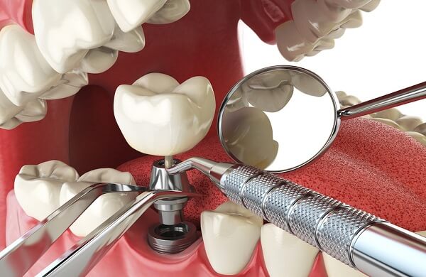 Cấy ghép Implant phục hồi răng mất
