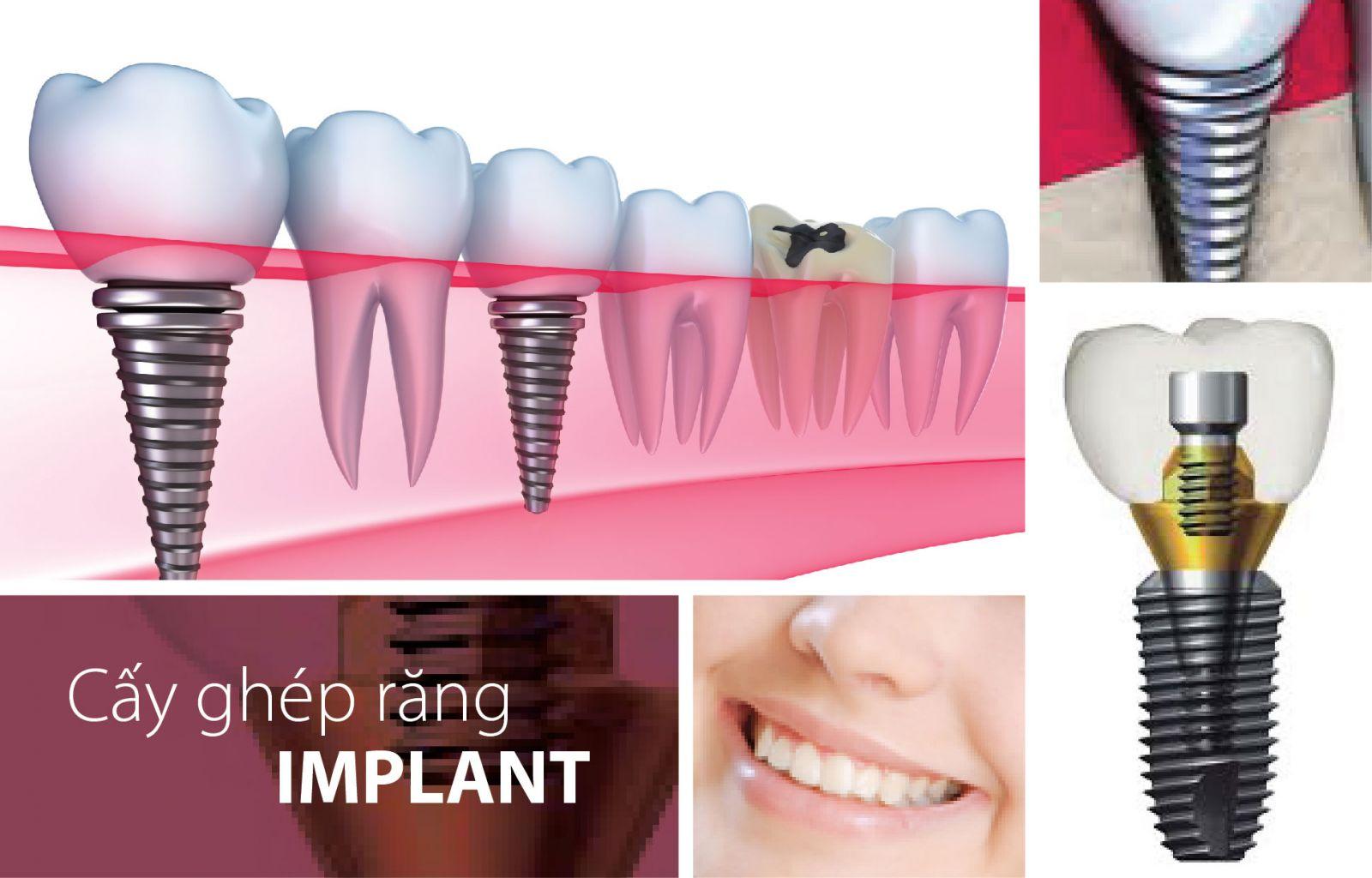 cấy ghép implant có tốt không