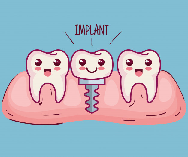 cấy ghép răng implant ở đâu tốt