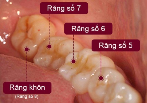 Chăm sóc như thế nào sau khi nhổ răng khôn