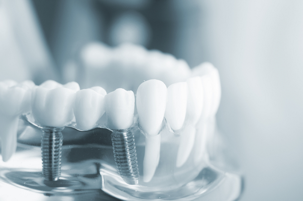 Chăm sóc răng trước, trong và sau khi trồng implant Chăm sóc răng trước, trong và sau khi trồng implant