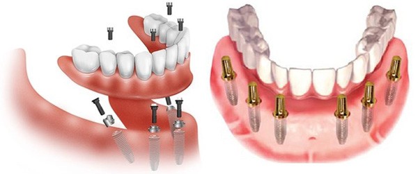 Chăm sóc răng trước, trong và sau khi trồng implant
