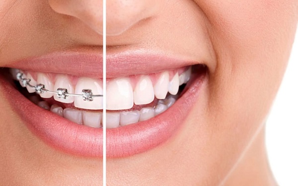 Chỉnh răng móm bằng phương pháp niềng răng