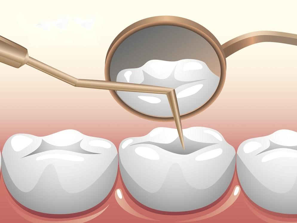 Chữa tuỷ răng mất thời gian bao lâu mới xong?