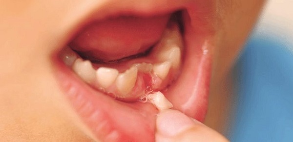Chữa viêm tủy răng sữa cho trẻ em Chữa viêm tủy răng sữa cho trẻ em