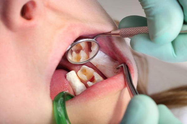 Chữa viêm tủy răng sữa cho trẻ em Chữa viêm tủy răng sữa cho trẻ em