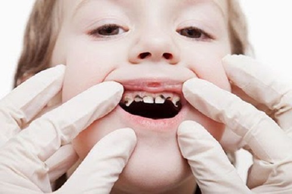 Chữa viêm tủy răng sữa cho trẻ em 