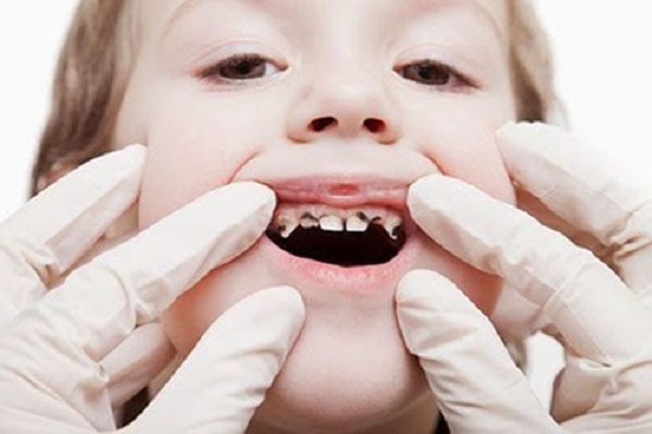 Chữa viêm tủy răng sữa cho trẻ em Chữa viêm tủy răng sữa cho trẻ em
