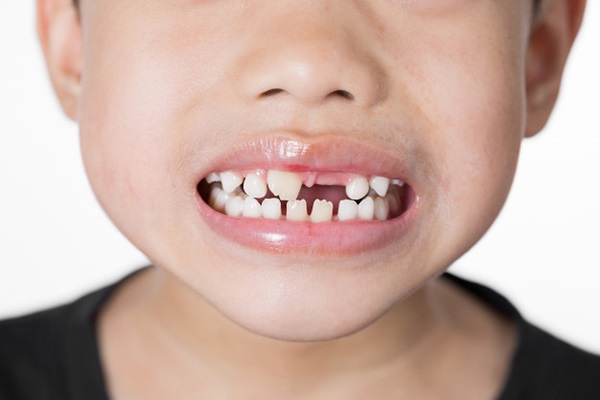 Chữa viêm tủy răng sữa cho trẻ em Chữa viêm tủy răng sữa cho trẻ em