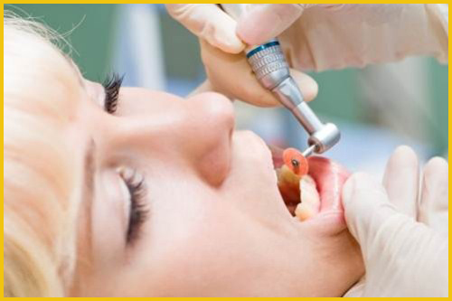 Có cần phải kiêng cữ sau khi cạo vôi răng Có cần phải kiêng cữ sau khi cạo vôi răng