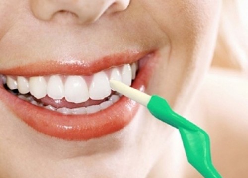 Có cần phải kiêng cữ sau khi cạo vôi răng Có cần phải kiêng cữ sau khi cạo vôi răng