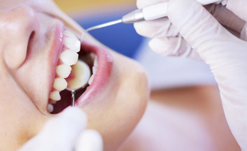 Có cần phải kiêng cữ sau khi cạo vôi răng Có cần phải kiêng cữ sau khi cạo vôi răng