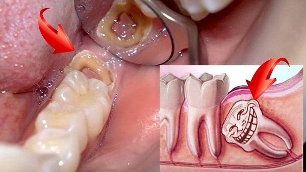 Có nên nhổ răng khôn mọc lệch mọc ngầm hay không