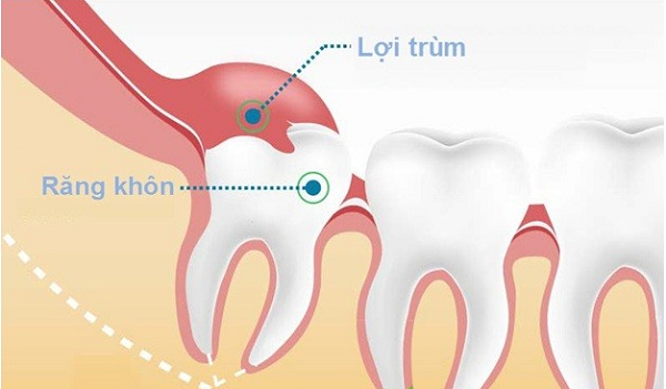 Có nên nhổ răng khôn mọc lệch mọc ngầm hay không