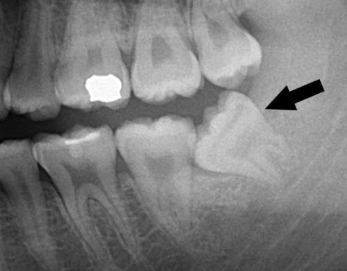 Có nên nhổ răng khôn số 8 không Có nên nhổ răng khôn số 8 không