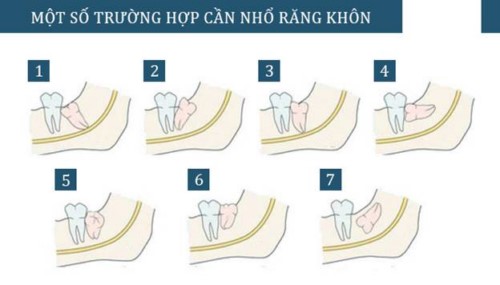 Có nên nhổ răng khôn số 8 không Có nên nhổ răng khôn số 8 không