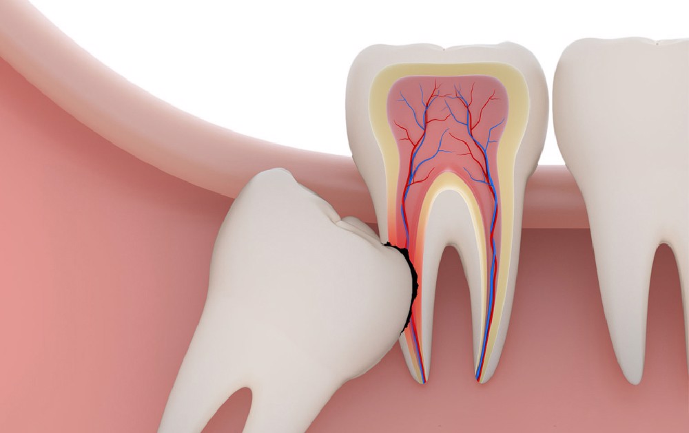 Có nên nhổ răng khôn số 8 không Có nên nhổ răng khôn số 8 không