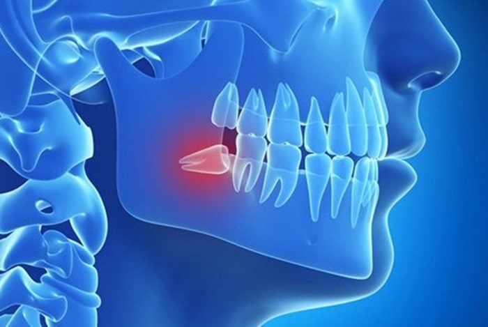 Có nên nhổ răng khôn số 8 không Có nên nhổ răng khôn số 8 không