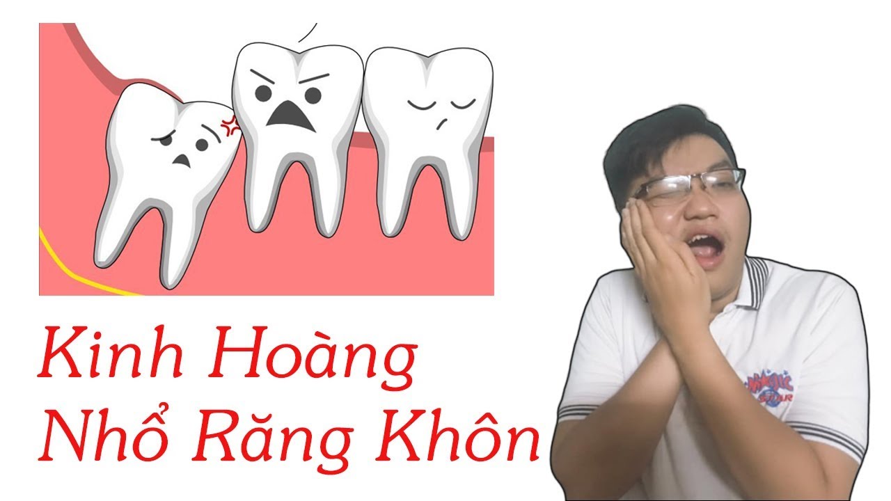 Có nên nhổ răng khôn số 8 không Có nên nhổ răng khôn số 8 không