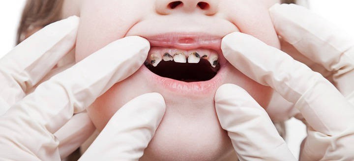 Có nên trám răng sữa sâu cho trẻ em hay không Có nên trám răng sữa sâu cho trẻ em hay không