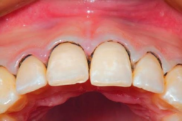 Dấu hiệu của bệnh viêm nha chu Dấu hiệu của bệnh viêm nha chu