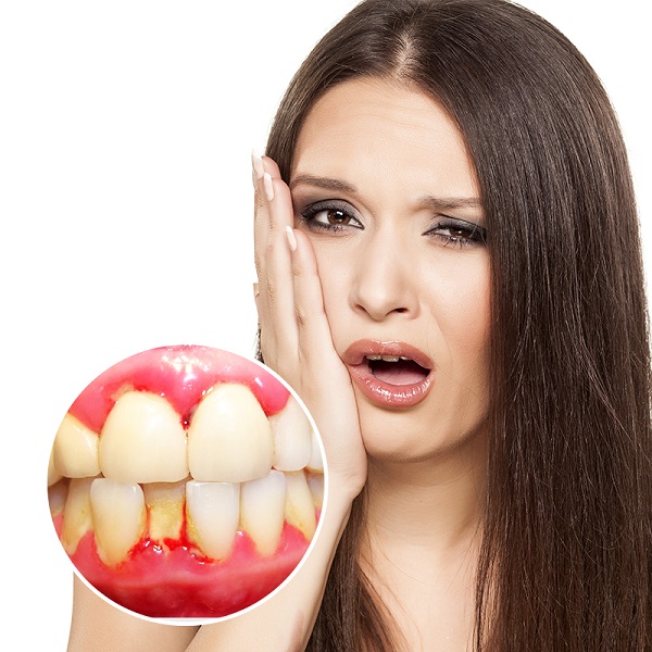 Dấu hiệu của bệnh viêm nha chu Dấu hiệu của bệnh viêm nha chu