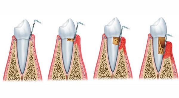 Dấu hiệu của bệnh viêm nha chu
