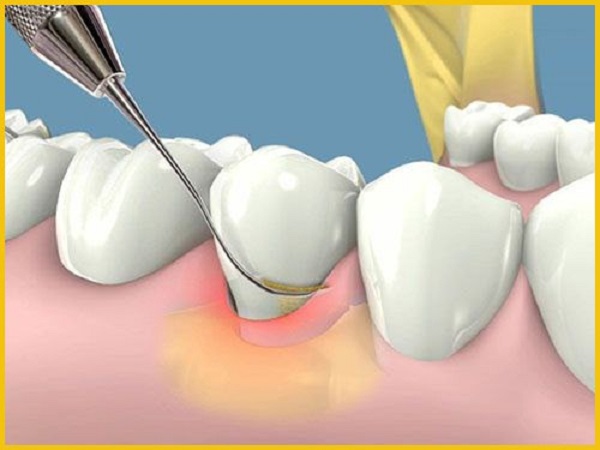 Dấu hiệu của bệnh viêm nha chu Dấu hiệu của bệnh viêm nha chu