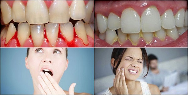 Dấu hiệu của bệnh viêm nha chu Dấu hiệu của bệnh viêm nha chu