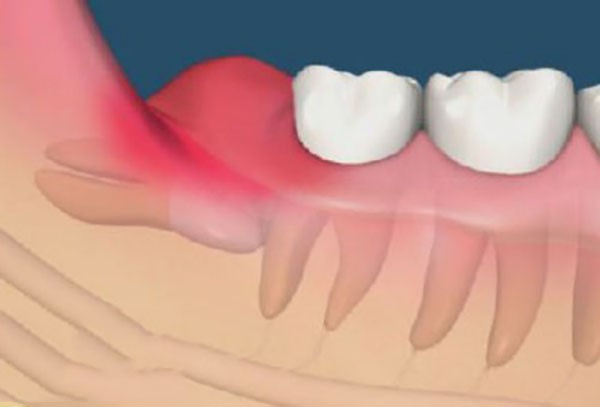 Dấu hiệu nhân biết khi mọc răng khôn Dấu hiệu nhân biết khi mọc răng khôn