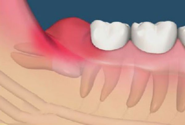 Dấu hiệu nhân biết khi mọc răng khôn