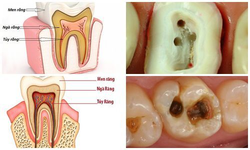 Nội nha (chữa tủy) Nội nha (chữa tủy)