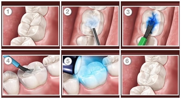 Trám răng thẩm mỹ