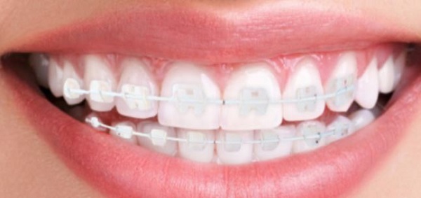 Độ tuổi nào là tốt để niềng răng và các loại niềng răng