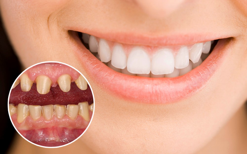 giai đoạn nào nên bọc răng sứ giai đoạn nào nên bọc răng sứ