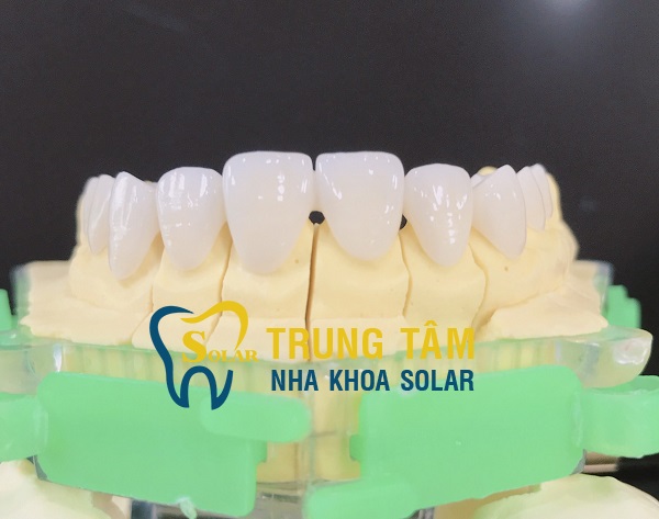 Hàm răng xỉn màu trở nên trắng sáng hoàn hảo nhờ bọc răng sứ Cercon HT