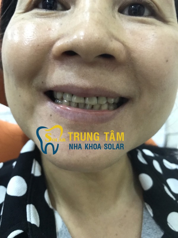 Hàm răng xỉn màu trở nên trắng sáng hoàn hảo nhờ bọc răng sứ Cercon HT