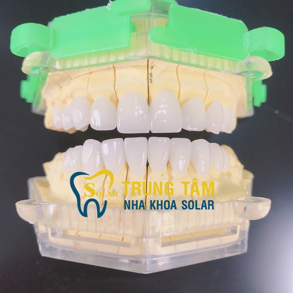 Hàm răng xỉn màu trở nên trắng sáng hoàn hảo nhờ bọc răng sứ Cercon HT