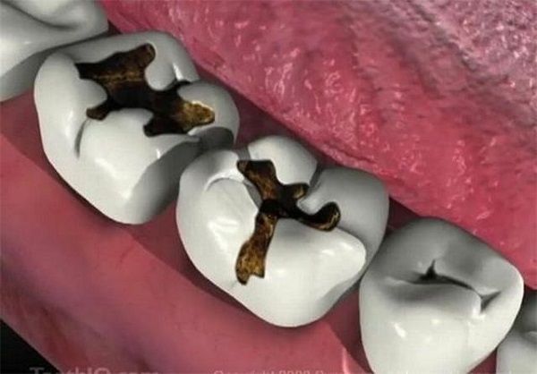 Làm sao để giữ bộ răng sứ trắng đẹp Làm sao để giữ bộ răng sứ trắng đẹp