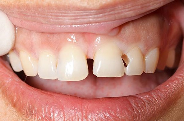 Làm sao để giữ bộ răng sứ trắng đẹp Làm sao để giữ bộ răng sứ trắng đẹp