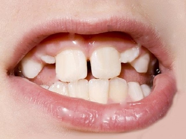 Làm sao để giữ bộ răng sứ trắng đẹp