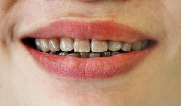 Làm sao để giữ bộ răng sứ trắng đẹp Làm sao để giữ bộ răng sứ trắng đẹp