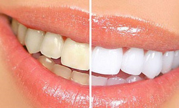 Làm sao để giữ bộ răng sứ trắng đẹp Làm sao để giữ bộ răng sứ trắng đẹp