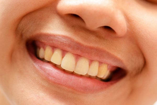 Làm sao để làm trắng răng bị ố vàng Làm sao để làm trắng răng bị ố vàng