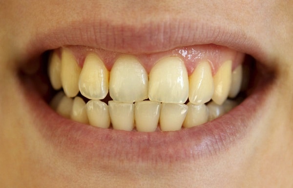 Làm sao để làm trắng răng bị ố vàng