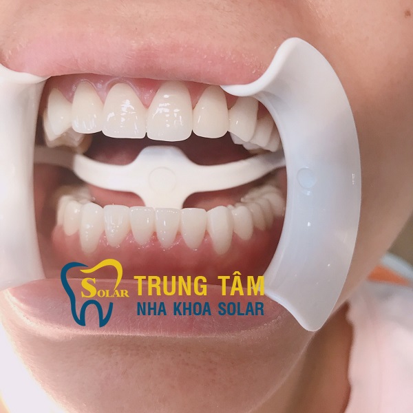 Làm thế nào để giảm thiểu rủi ro khi bọc răng sứ