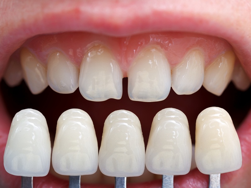 Làm thế nào để giảm thiểu rủi ro khi bọc răng sứ